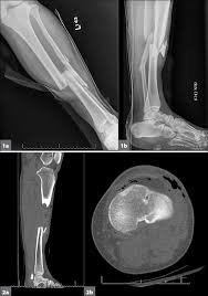 Image result for Open Fracture