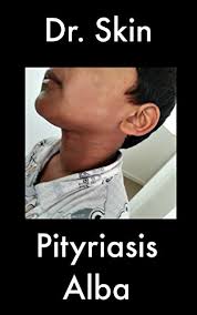 Pityriasis refers to the characteristic fine scale, and alba to its pale colour (hypopigmentation). Pityriasis Alba English Edition Ebook Skin Dr Amazon De Kindle Shop