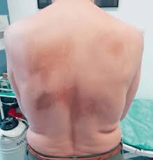 Image result for Notalgia Paresthetica