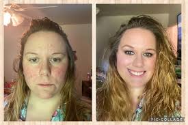 Makeup for rosacea coverage recommendations