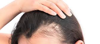 If you get your stress under control, your hair might grow back. Hair Transplant For Women Medicinal Istanbul
