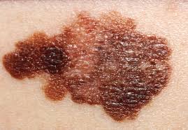 Read on to know more. Melanoma Wikipedia