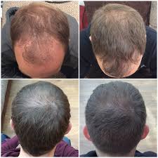 Capital hair and beauty norwich. Capital Hair Restoration Norwich
