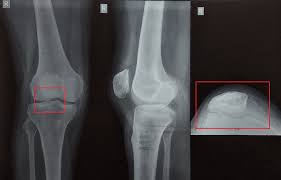 Image result for Patellar Dislocation