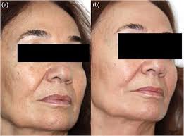 Image result for Solar Lentigo