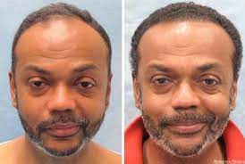 When you are stressed out you can trigger a lot of hair loss sue to the levels of stress that you are experiencing. New Breakthrough Solution Leaves Men With Full Head Of Hair Reverse Hair Loss And Re Grow Hair Naturally