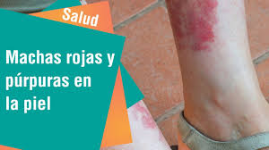 Maybe you would like to learn more about one of these? Que Indican Las Manchas Rojas Y Purpuras En La Piel Salud Youtube