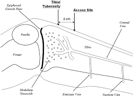 Image result for Intraosseous Access