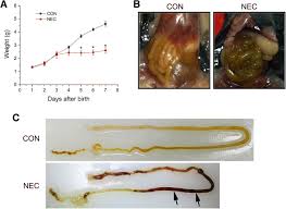 She developed a fatal gastrointestinal disease common in premature babies called necrotizing enterocolitis, and she died at the age of 2 months. Recessed Lighting Installation Necrotizing Enterocolitis Pathophysiology Necrotizing Enterocolitis Review Of State Of The Art Imaging Findings With Pathologic Correlation Radiographics Necrotizing Enterocolitis Nec Is Not A New Disease
