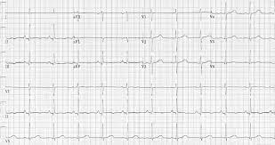 Supraventricular Tachycardia Svt Litfl Ecg Library Diagnosis