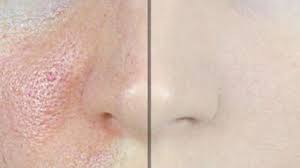 Topsante Org Astuces Beaute Pores Dilates Peau Grasse