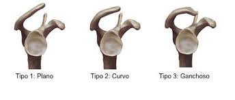 Bigliani type ii anterior acromial process. O Que E O Acromio E Qual Sua Relacao Com A Dor No Ombro Dr Jorge