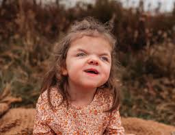 Hope for Hailie: A Journey with Apert Syndrome & Angelman Syndrome