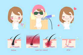 Patient comfort is one of our top. Benefits Of Painless Laser Hair Removal Best Laser Room London