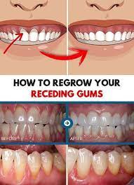 Will I Lose My Teeth If I Have Periodontal Disease Receding Gums Teeth Health Gum Care