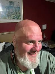 Sunburn from 9 hours of Florida sun