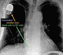 Pacemakers and implantable cardioverter defibrillators (icd) both use wires called leads to send electrical signals to the heart. Cxr Iii Springerlink