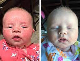 Baby Acne Before And After Using This Lavender Scented Baby Cream Organic Toxinfree Glutenfree Babyskincare Available Baby Skin Care Baby Acne Diaper Cream