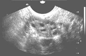 Ovarian cancer tends to present with a pelvic mass, so i've included a differential diagnosis for this. Pelvic Ultrasound