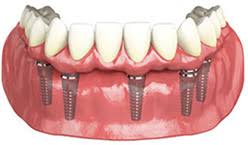Check spelling or type a new query. Full Mouth Belfast Sandown Dental Implant Clinic