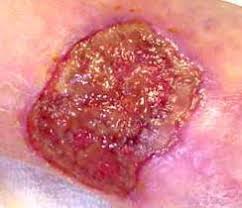 Last, pat it dry with clean gauze or a clean cloth. Management Of Exudate And Infection Wound Care Education Clinimed