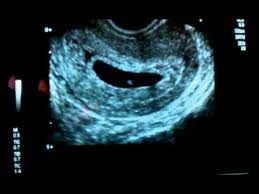 Been nausious since week 6 wish nausia and tiredness would end. 6 Week Ultrasound Of Baby Parker With Heartbeat Youtube