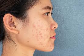 Image result for acne face