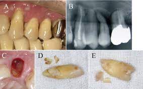 Aging, trauma and occlusal overload are the main aetiological factors. Multiple Cemental Tears Oral Surgery Oral Medicine Oral Pathology And Oral Radiology
