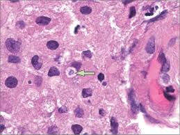 Image result for Rhodococcus equi