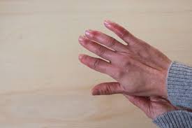 Image result for Chilblains