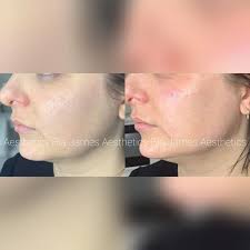 Cheek, chin & jaw filler to gain definition in jaw and cheek also  projection in chin #caerphillysalon #caerphillyaesthetics #chinfiller  #cheekfiller #jawfiller #jawline #caerphillyfiller
