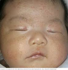 Be aware of moles on your body which are irregular in shape, colour should you have any concerns about your health, or of that of your baby or child, please consult with. Baby Acne Symptoms And Causes Mayo Clinic