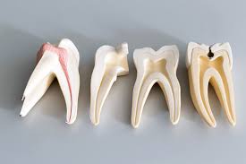 If your tooth has experienced any injury or trauma, then it could be the reason behind that crown sore. Why Do I Need A Root Canal Treatment If My Tooth Doesn T Hurt