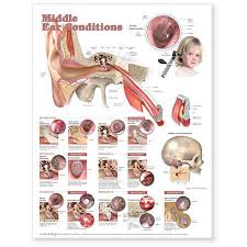 Middle Ear Conditions Unmounted Chart Middle Ear Conditions