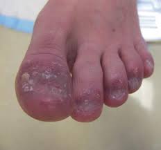 Image result for Onycholysis feet