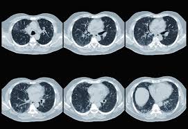 Biomarkers Predictive Of Systemic Sclerosis Interstitial Lung Disease Identified Pulmonology Advisor