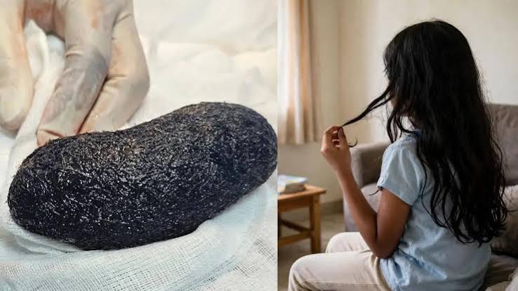 Doctors remove 1 kg of hair from 9-year-old Kerala girl's stomach in rare Rapunzel syndrome case | Mathrubhumi English