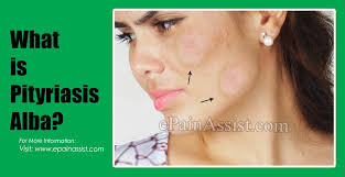 The name refers to its. Pityriasis Alba Causes Symptoms Treatment Is It Contagious