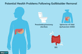 gallbladder removal what to eat for better management