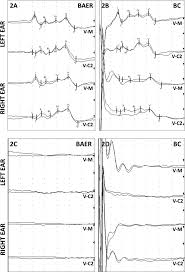 Brainstem auditory evoked responses and bone conduction assessment in  alpacas