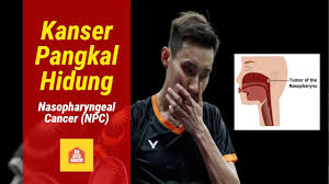 Jangan lupa untuk membookmark kanser pangkal rahim in english menggunakan ctrl d (pc) atau command d (macos). Kanser Pangkal Hidung Nasopharyngeal Cancer Npc Youtube