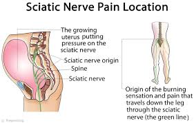 Sciatica symptoms include pain that people typically feel from the low back to behind the thigh and radiating down below the knee. Sciatica While Pregnant Maternal Massage