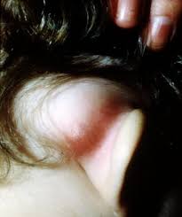Image result for Mastoiditis