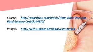 How much does a gastric balloon cost & what are your payment options? How Much Does Lap Band Surgery Cost