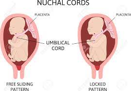 Umbilical Cord Around Neck Two Types Of Nuchal Cord Free Sliding Royalty Free Cliparts Vectors And Stock Illustration Image 144157538