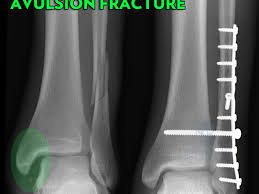 If the fracture is not out of place or is a very low fracture with very small pieces, it can be treated without surgery. 5 Kinds Of Medial Malleolus Ankle Fractures