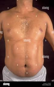 Image result for Lipodystrophy