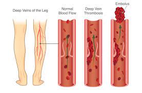 The mainstay of therapy for dvt is anticoagulation, provided there is no. What Is Dvt Deep Vein Thrombosis Symptoms Treatment More Sonas