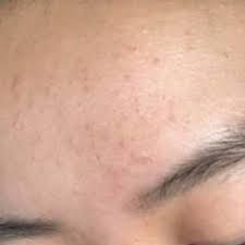 Regular (bacterial) acne breakouts vary in size and tend to feature blackheads or whiteheads on the face, dr. Redditor Shares Transformative Fungal Acne Routine See Her Before After Photos Allure