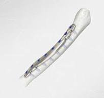 Clavicle compression plate - LOQTEQ® 2.7 - aap Implantate ...